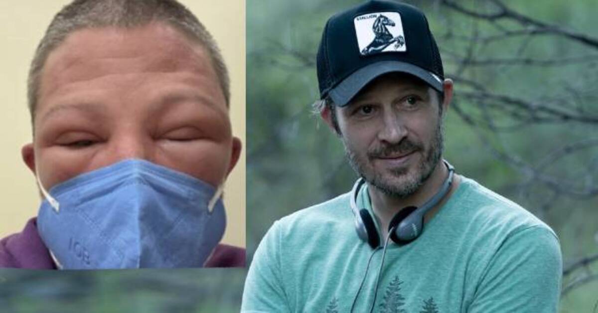 Zach Gilford yüzündeki şişlik yüzünden tanınmaz hale geldi